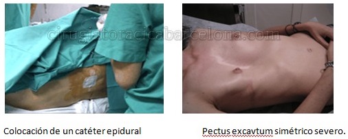 cateter epidural